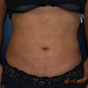 Front shot two months after lipo