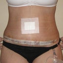 My incision comes further over on my right side, not sure why.