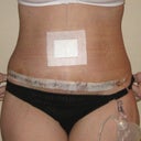 POD 3.  So swollen, but I can't see any stretchmarks.  I'm sure I'll still have some on my sides.