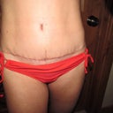 wk 6 the scar. you can also see the lower ab swelling.