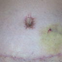 Incision area Day 17 PO