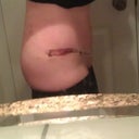 To the other! Swelling is minimal at this point and scar and belly button look good!