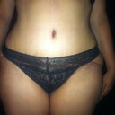 notice the visible scar below the panty line