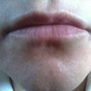 This was my lip before