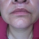 This is 1 week after,. stitches removed today. I continue to apply aloe and vitamen E