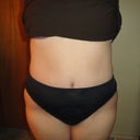 9 weeks Post Op