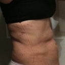 Side view post 2 days