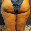 Back thighs pre (post tummy which is where the left swelling is from)