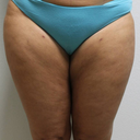 Front thighs 2 months