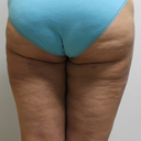 Back thighs 2 months