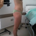 day of surgery side shot
