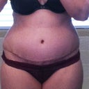 2 weeks PO - scar