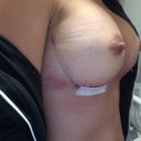side view see bruising post op day 1 after shower