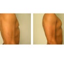Pec Implant Augmentation