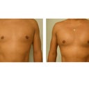 Pec Implant Augmentation