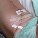 The butterfly strips mark the edges of the blowout, which was on the curve of incision. Blowout Sat 8/27 and photo is Mon 8/29