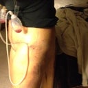 6 day Bruising of legs