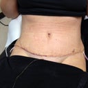 6 Day Check Up    Pain Pump Removal