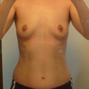 2 weeks after surgery