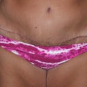 Scar after 33 days