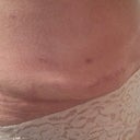Dog ear on right side. kinda hard to tell but its like a pocket of fat! gross