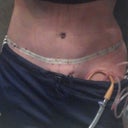 2DPO.  Lots of swelling, but I think the scar looks good as does the belly button.