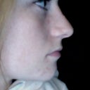 something like what im hoping for, same nose, same size just take that damn bump away!