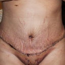 2 days after surgery