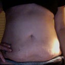 Tummy Front View PreOp.