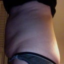 Tummy Left View PreOp.