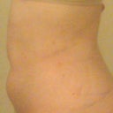 sharpie lines, side view morning after procedure