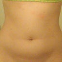 1 month after procedure