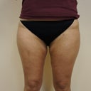 1 Month After Lipo - No more rubbing!
