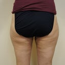 1 Month After Lipo - bulge is gone