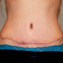 4 week scar