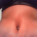 Close up of two weeks post op belly button