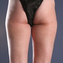 Back of legs - 6 months post procedure