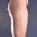 Side view 7.5 months post procedure