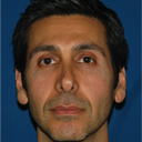 Revision Rhinoplasty