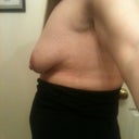 before surgery- floppiness