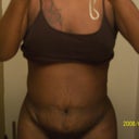 Front View 2 week post op