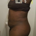 Side view 2 week post op