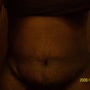 Front View 2 week post op