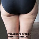 After Velashape
