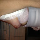 Breast 5 day post op
