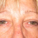 Three mos after frist surgery