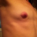 1 month post right-sided nipple scar revision