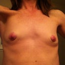 1 month post right-sided nipple scar revision...better :)