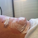 Immediately after suction came off before it was massaged back down