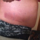 Love handles as you can see there is brusing.  All pictures are night of procedure.